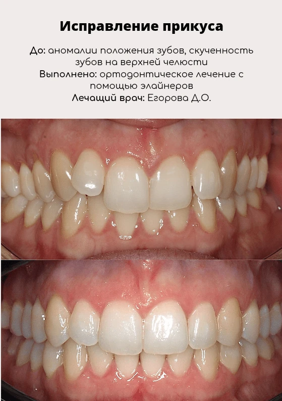 Эстетическая реставрация / Элайнеры