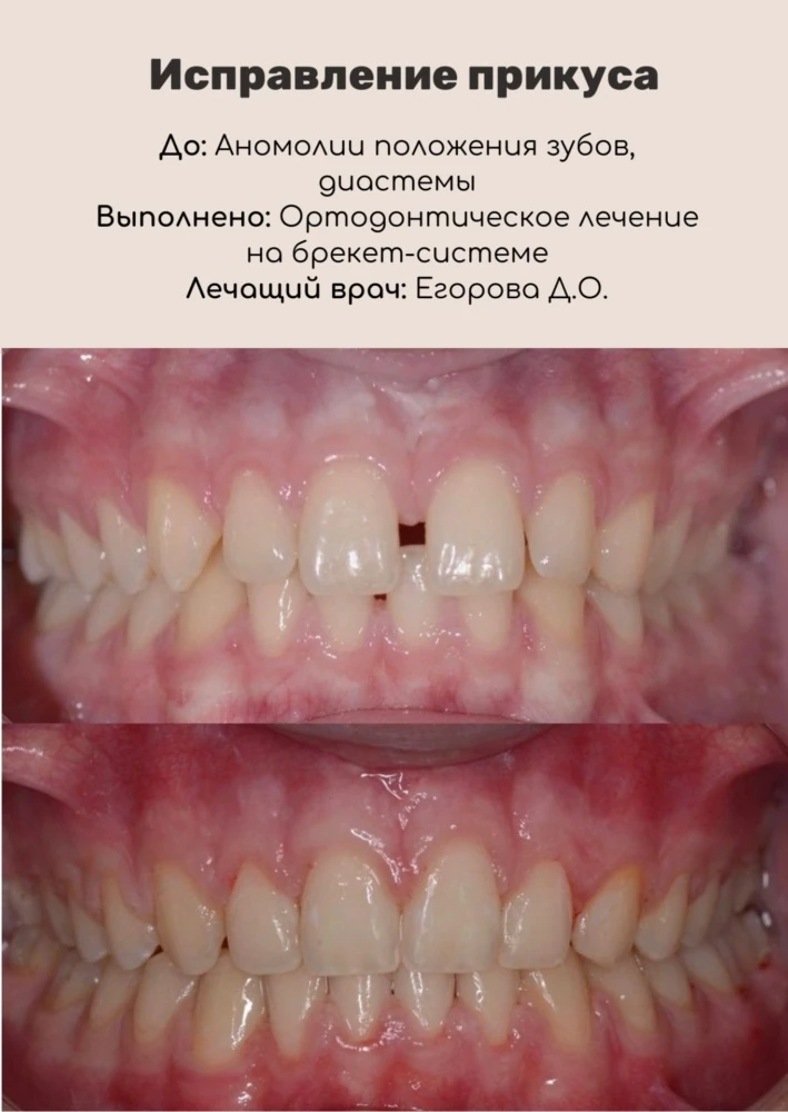 Исправление прикуса