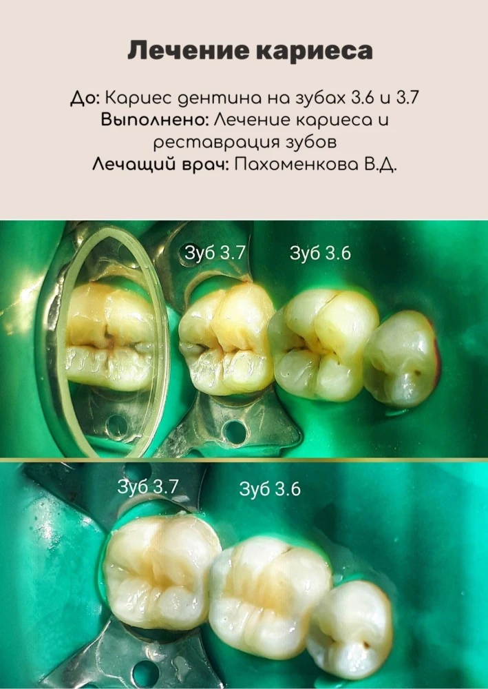 Лечение сложного кариеса