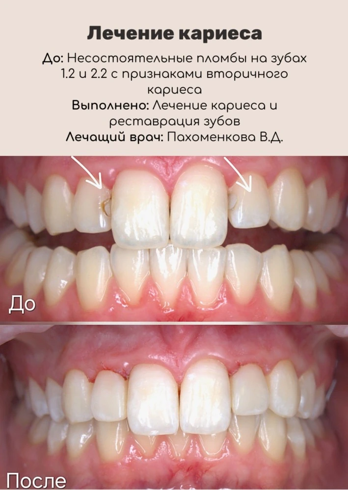 Лечение сложного кариеса