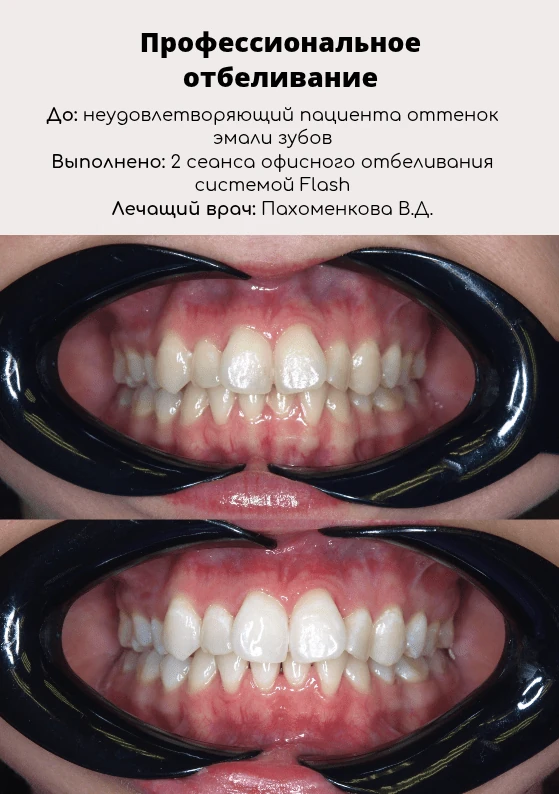 Профессиональное отбеливание