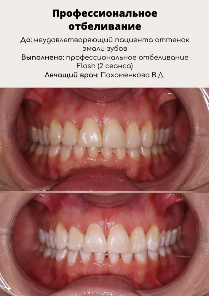 Профессиональное отбеливание