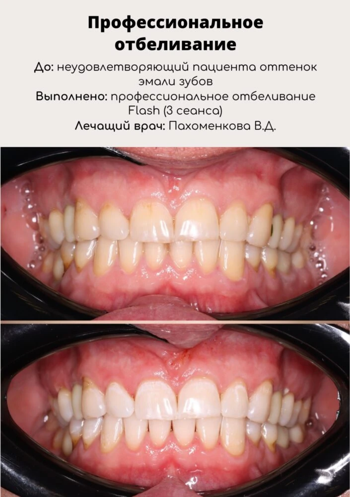 Профессиональное отбеливание