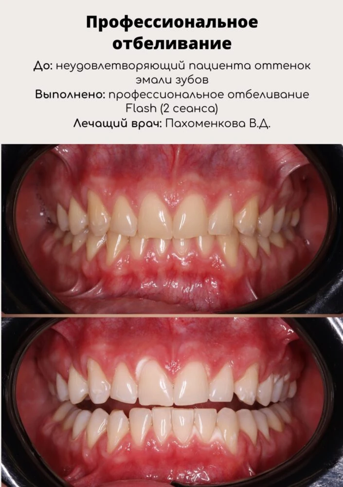 Профессиональное отбеливание