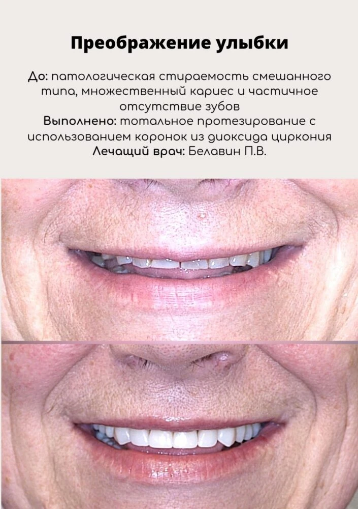 Протезирование