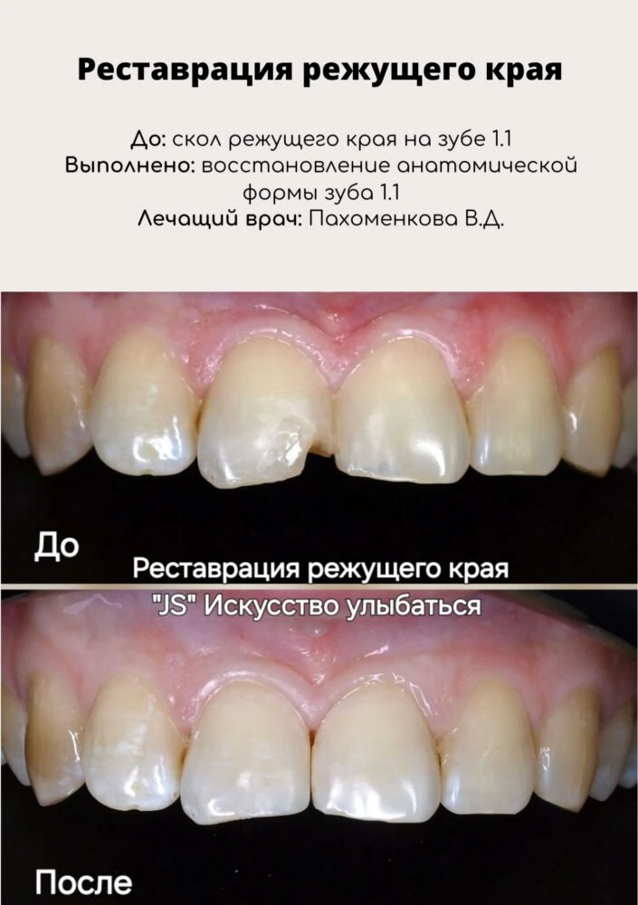 Эстетическая реставрация / Элайнеры
